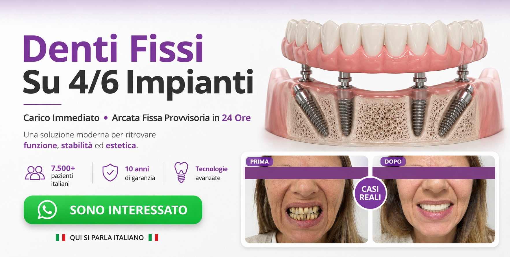 denti fissi all on 4 impianti dentali turismo dentale dentista bucarest romania 02 dnew
