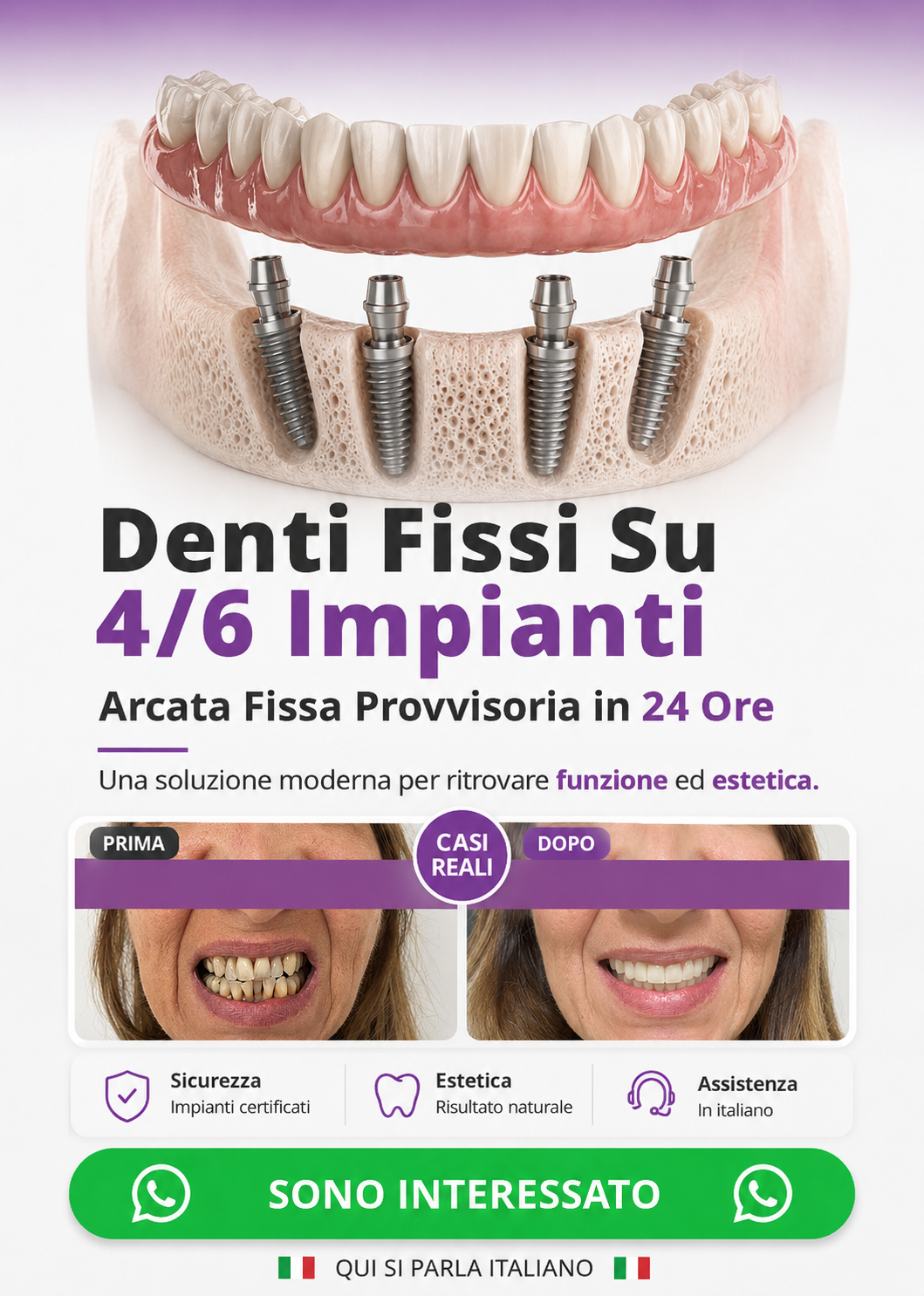 denti fissi all on 4 impianti dentali turismo dentale dentista bucarest romania 02 mnew