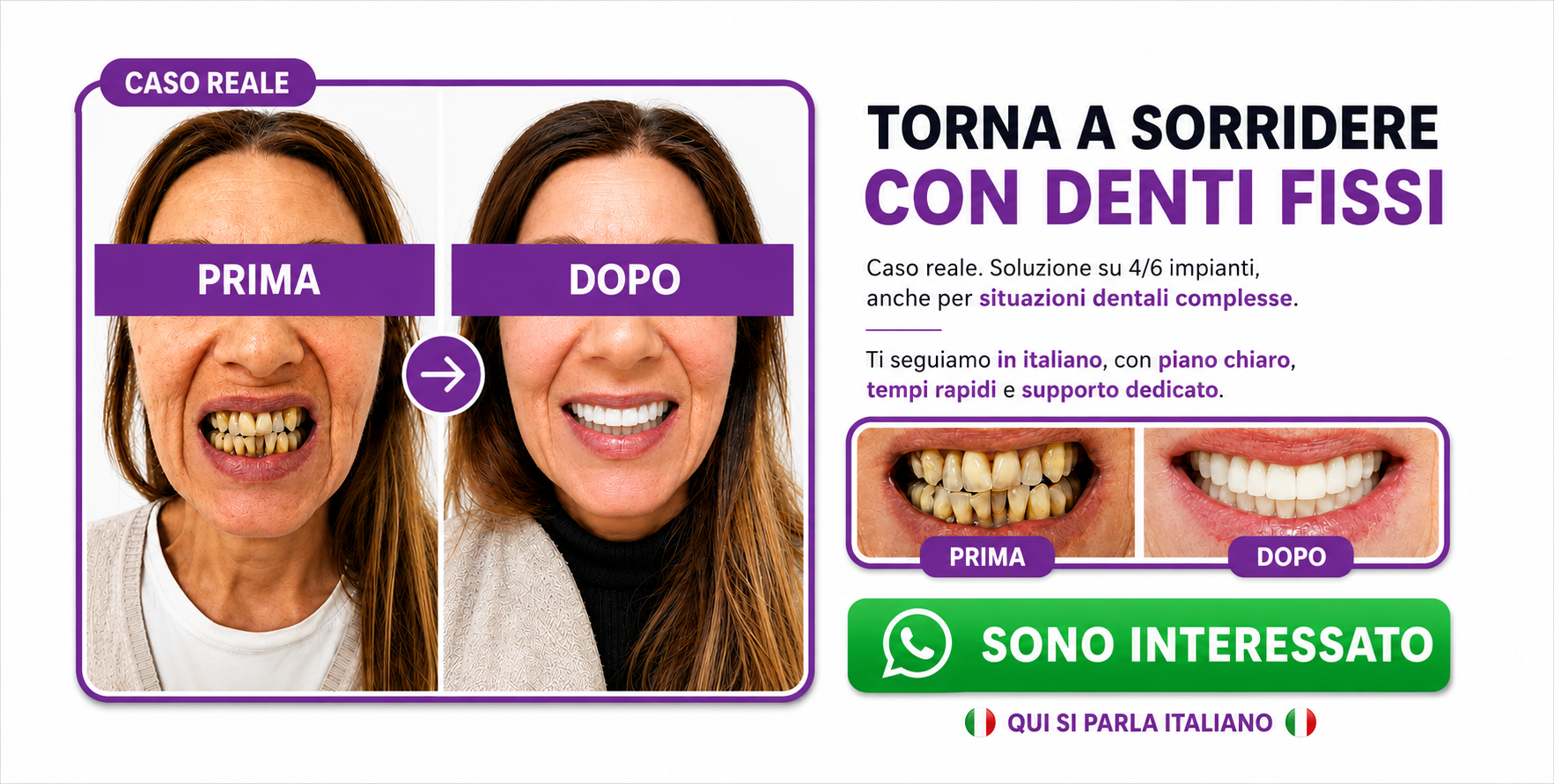 denti fissi all on 4 impianti dentali turismo dentale dentista bucarest romania A d