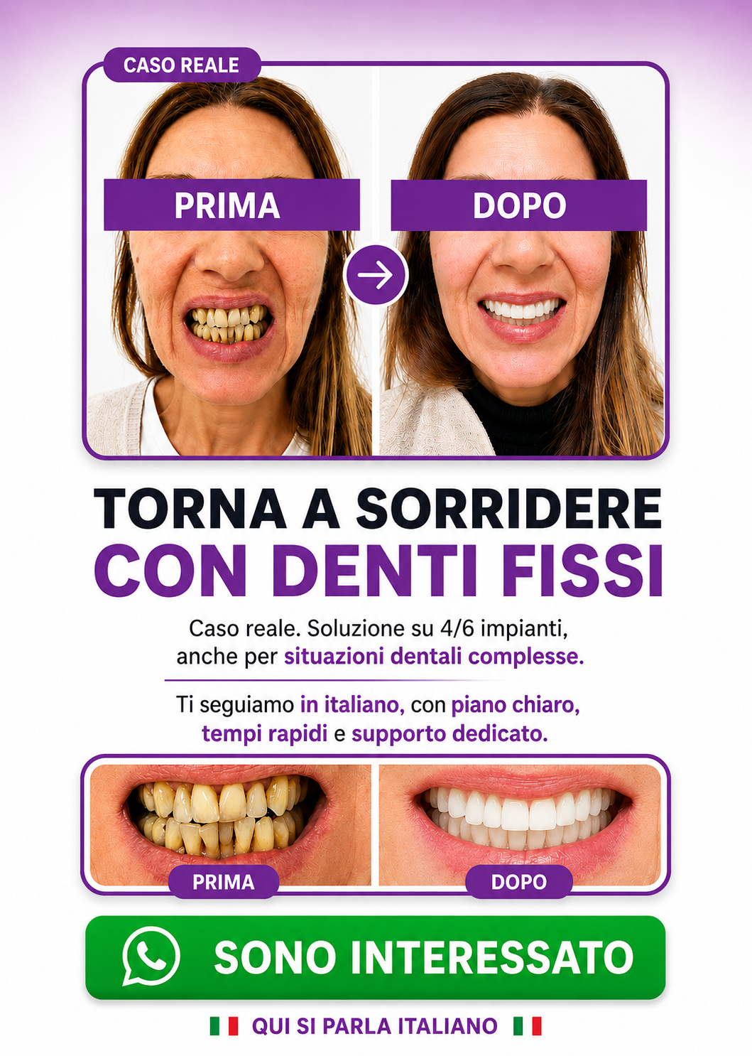 denti fissi all on 4 impianti dentali turismo dentale dentista bucarest romania A m