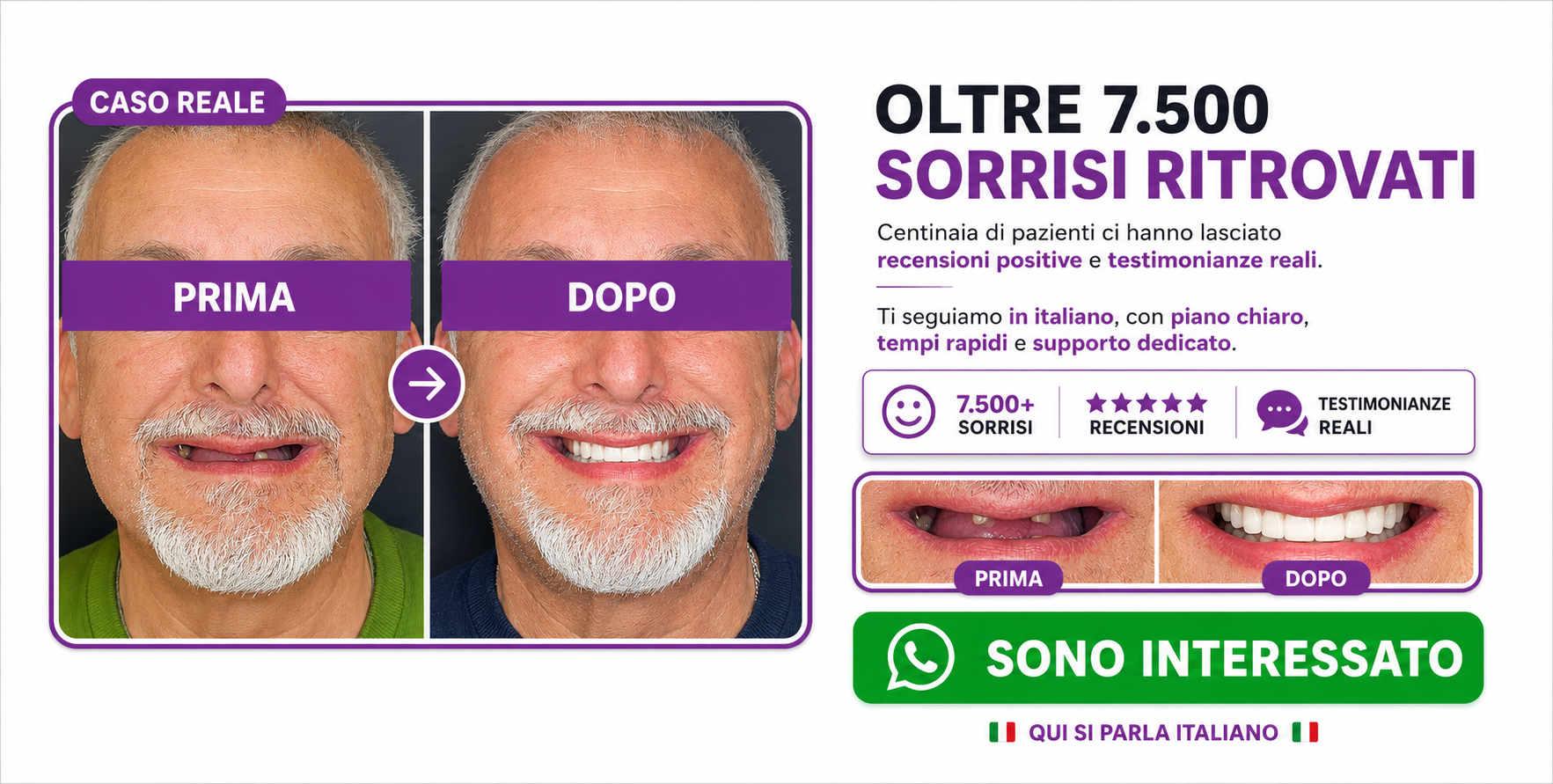 denti fissi all on 4 impianti dentali turismo dentale dentista bucarest romania D d